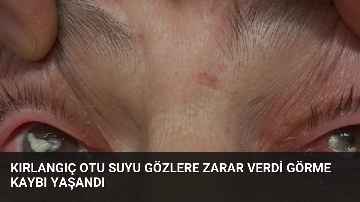 Kırlangıç Otu Suyu Gözlere Zarar Verdi Görme Kaybı Yaşandı