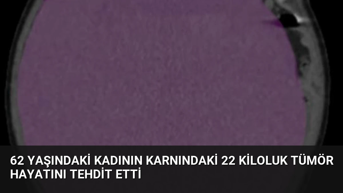 62 Yaşındaki Kadının Karnındaki 22 Kiloluk Tümör Hayatını Tehdit Etti